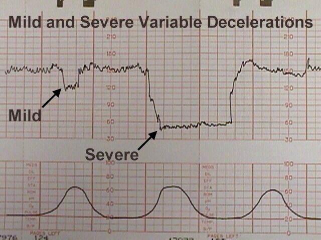 Baby retailer heart rate and contraction monitor